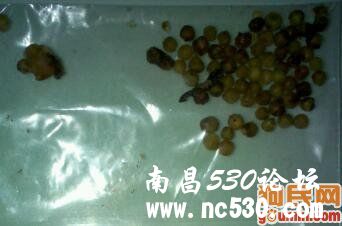 膀胱结石--服用三金片还是肾石通？